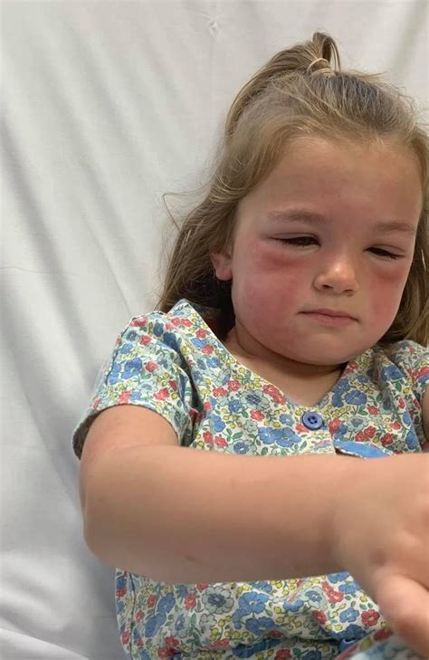 Girl Suffers Severe Allergic Reaction To Caterpillar Prompting Warning