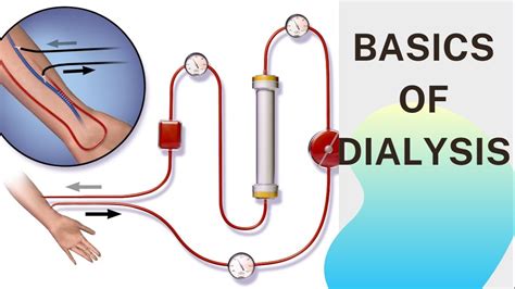 Basic Concept Of Dialysis Machine Fresenius 4008s Dialyzer