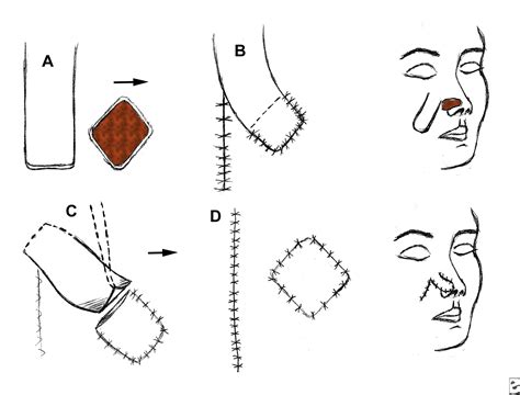 Oral And Maxillo Facial Surgery Flaps Classification