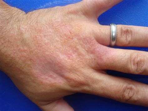 Nummular Dermatitis 10 Symptoms Of Nummular Dermatitis