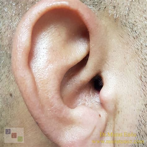 Two Months After Endoscopic Eardrum Repair