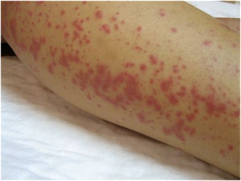 Maculopapular Rash Causes Symptoms Treatment Pictures Diagnosis HealthMD