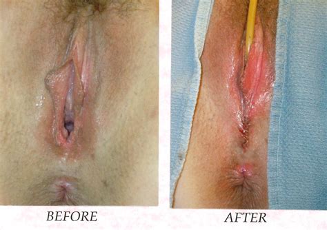 Labiaplasty Arizona Cosmetic Vaginal Surgery