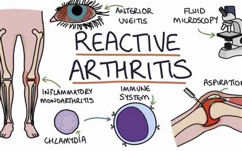 what is sexually acquired reactive arthritis ruclear