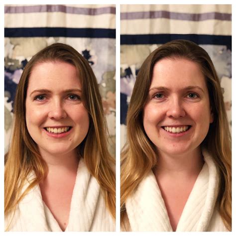 In fact, most people need to have them extracted. How to make your teeth look like you used a whitening ...