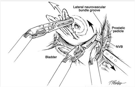 Robotic Nerve Sparing Radical Prostatectomy Department Of Urology