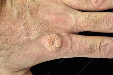Wart On Hand Stock Image C0473520 Science Photo Library