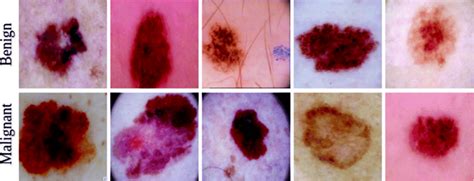 Examples Of Malignant Melanoma Lesions And Benign Lesions Download