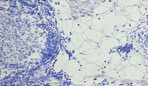 Immunohistochemical Image Of Basal Liketriple Negative Invasive Ductal