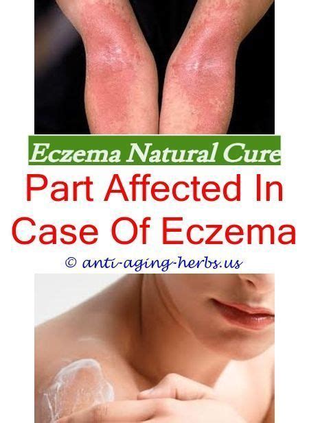 Pin On Eczema Routine