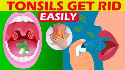 Tonsillitis How To Get Rid Of Tonsils Permanently And Easily Tonsil