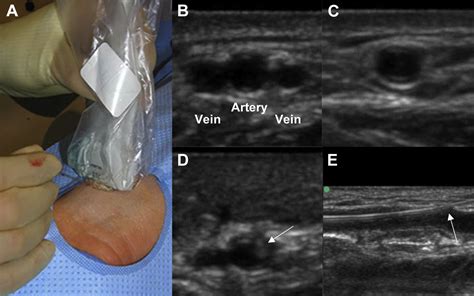 Real Time Ultrasound Guidance Facilitates Transradial Access Raust