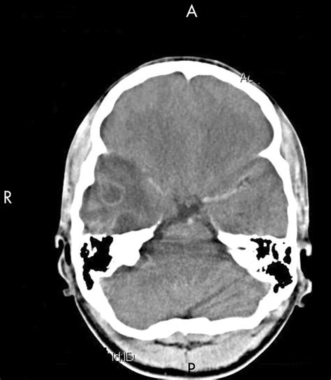 Ring Enhancing Lesion On Ct Scan Metastases Or A Brain Abscess