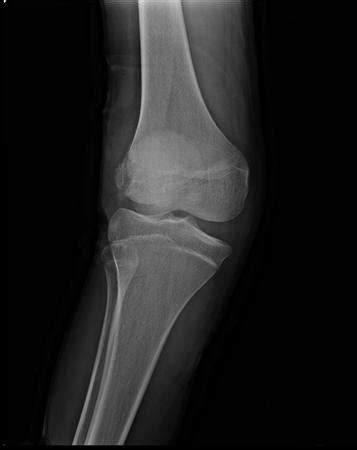 Pellegrini stieda syndrome is a medical problem which is characterized by pain, swelling and inflammation in the knee. MCL Knee Injuries - Knee & Sports - Orthobullets