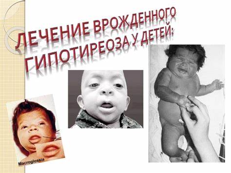 Врожденный гиподиреоз - online presentation Картинка - Врожденный гиподиреоз - online presentation