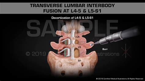 Transverse Lumbar Interbody Fusion At L4 5 And L5 S1 Medical Animation Youtube