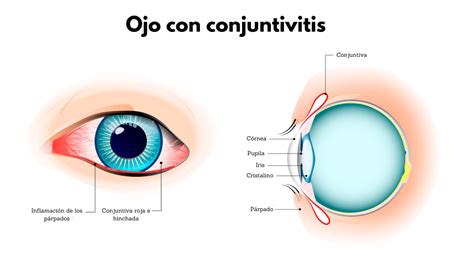 Conjuntivitis tipos y tratamientos Óptima Visión