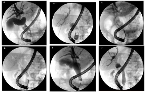 Wire Basket Sweep Ercp Bile Duct