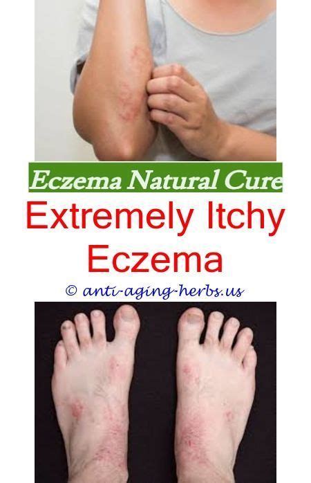 Eczema Disease Can Sunscreen Cause Eczema National Eczema Association