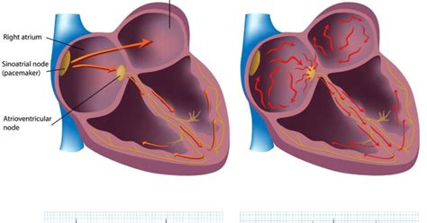 Definition Causes Symptoms Diagnosis And Treatment Of Atrial