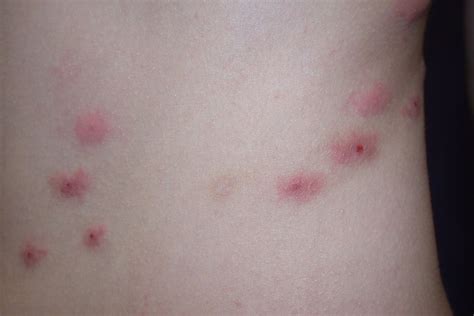 Flea Bite Allergic Reaction
