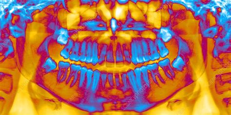 Wisdom Teeth Eruption Panoral X Ray Stock Image C0131070