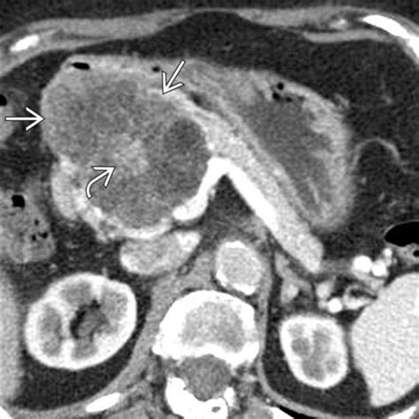 Pancreatic Serous Cystadenoma Radiology Key