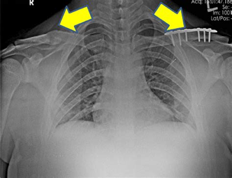 Cureus Bilateral Clavicle Fractures A Rare Injury