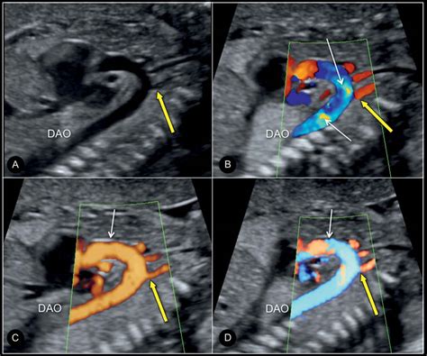 Color Doppler In Fetal Echocardiography Obgyn Key
