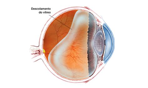 Descolamento Do V Treo Posterior Moscas Volantes Marques Eye