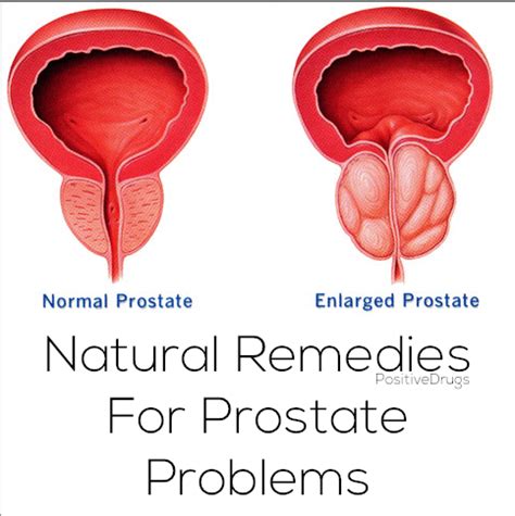 The prostatic fluid samples were taken by prostate massage for laboratory examination. natural remedies for prostate problems (With images ...