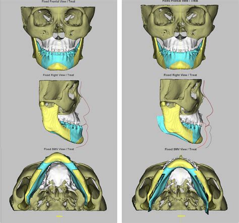 Type Of Maxillary Segment Mobilization Affects Three Dimensional Nasal