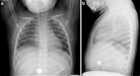 Anteroposterior A And Lateral B Chest Radiographs Of A 2 Year Old