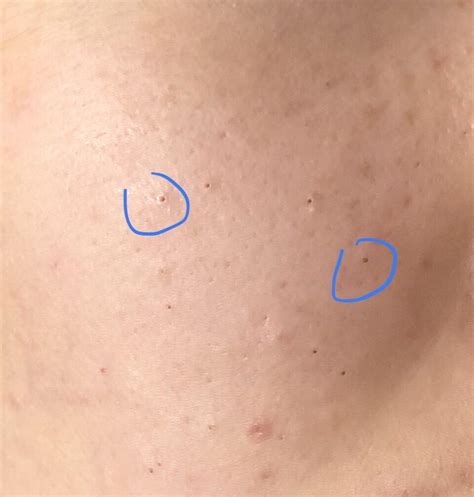 Can Someone Confirm If These Are Blackheads On My Cheek Or Something