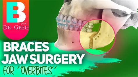 Braces Jaw Surgery For Overbite Correction Overjet Correction Youtube