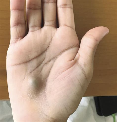 Man Develops Giant Blue Lump On Hand After Trip To Dentist Ladbible