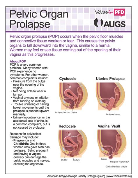 Prolaps Symptomer Prolaps Org