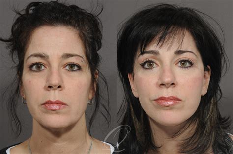 Eyelid Lift Before And After Photos Patient 74 Serving Rochester