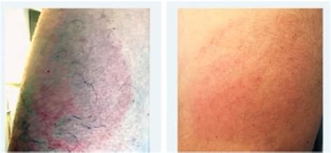Moderna vaccine leaves some patients with itchy (but harmless) rash. Moderna's Covid-19 jab can cause skin reactions 11 DAYS ...