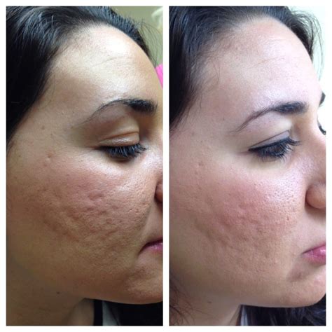 Microneedling | Collagen Induction Therapy | Lucy Peters Aesthetic Center