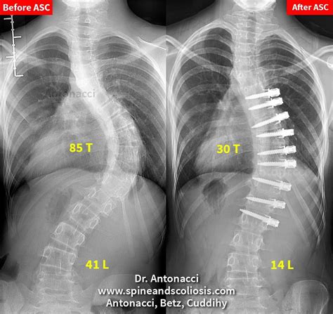 Pm 12 Scoliosis Single Complex Curve From 85 Thoracic Institute For