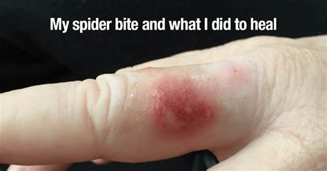My Spider Bite And What I Did To Heal Everywomanover29 Blog