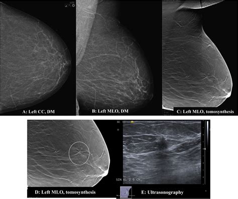 Digital Breast Tomosynthesis 3d Mammography Screening A Pictorial