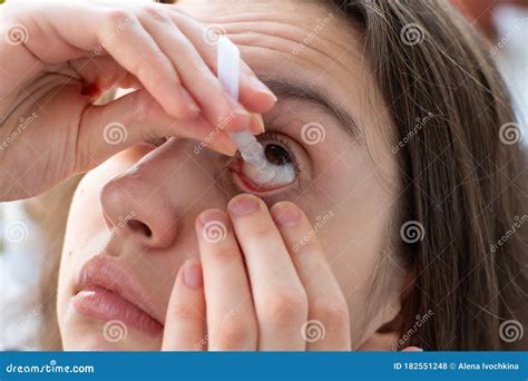 Close Up Of A Young Girl Dripping On Her Eye With Red Vessels To