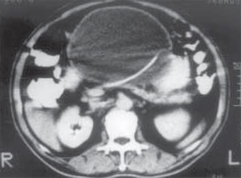 Contrast Enhanced Ct Scan Of Abdomen Axial View Shows A Large