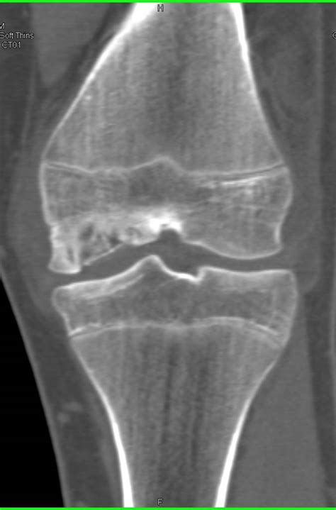 Avascular Necrosis Of Medial Femoral Condyle Musculoskeletal Case