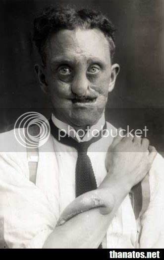 Facial Reconstructions On Injured Wwi Soldiers Pics Bodybuilding