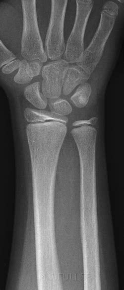 Radiography Of Subtle Wrist Fractures Wikiradiography