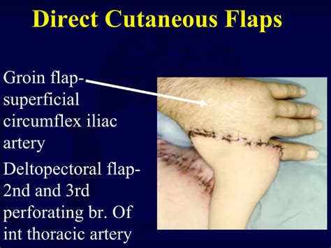 Wound Coverage Techniques Flaps —