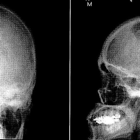 Anteroposterior And Lateral Skull Radiographs Showing The Lytic Lesion